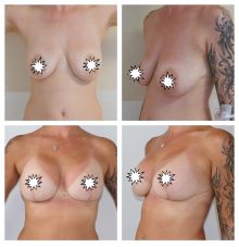 Augmentace - zvětšení prsou s modelací Dr. Veliký