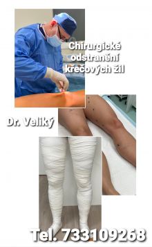 Odstranění varixů, křečové žíly